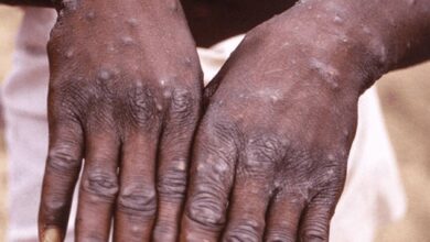 Photo of Un paciente haitiano en Ocoa es el décimo caso de viruela símica en RD